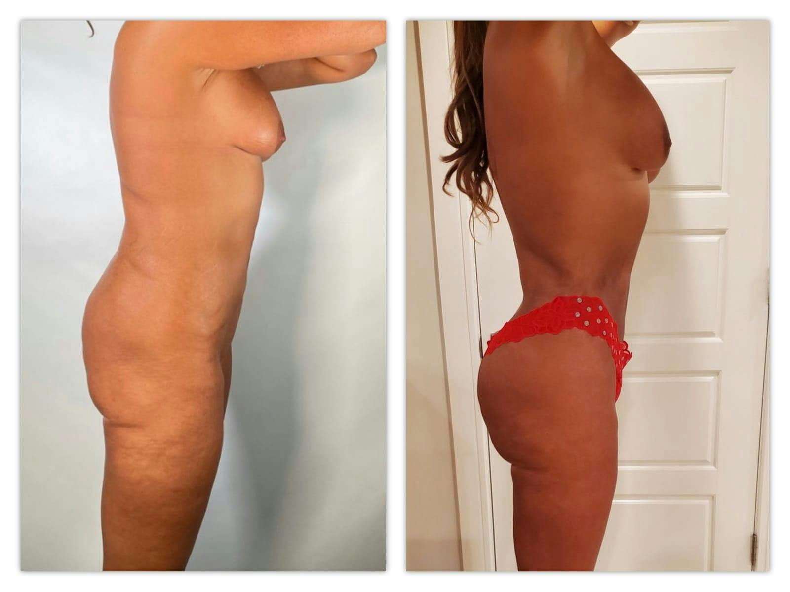 Brazilian Butt Lift Before & After Gallery - Patient 133213887 - Image 4