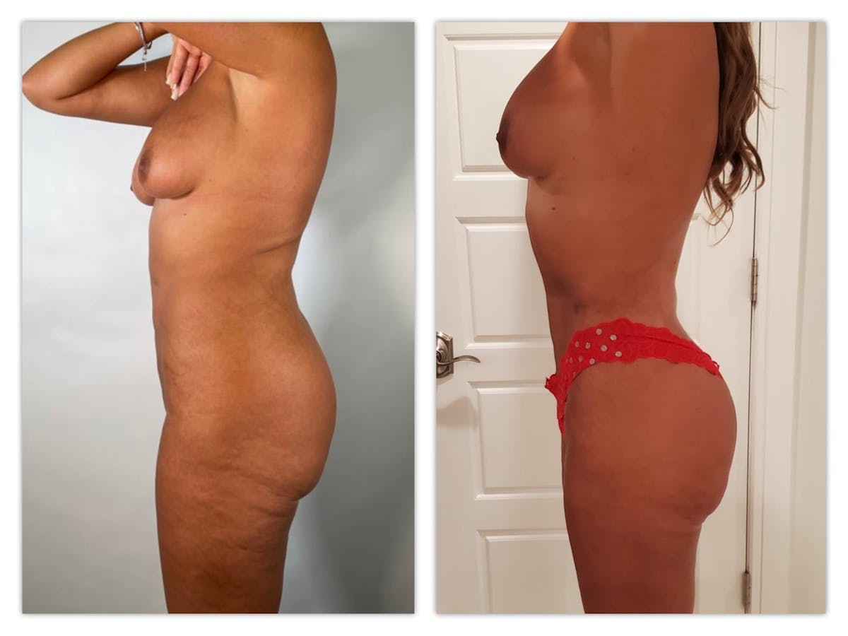 Brazilian Butt Lift Before & After Gallery - Patient 133183722 - Image 2