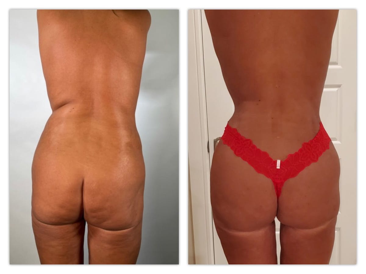 Brazilian Butt Lift Before & After Gallery - Patient 133213887 - Image 1