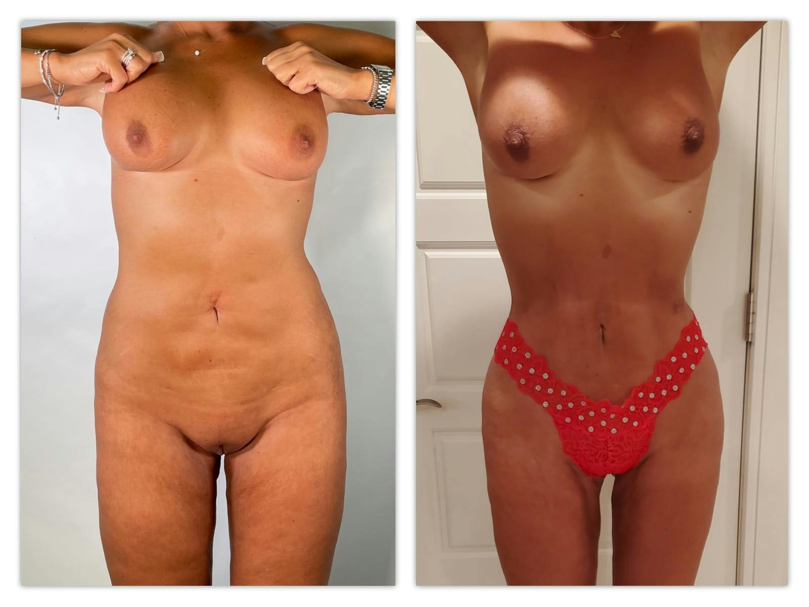 Brazilian Butt Lift Before & After Gallery - Patient 133183722 - Image 2