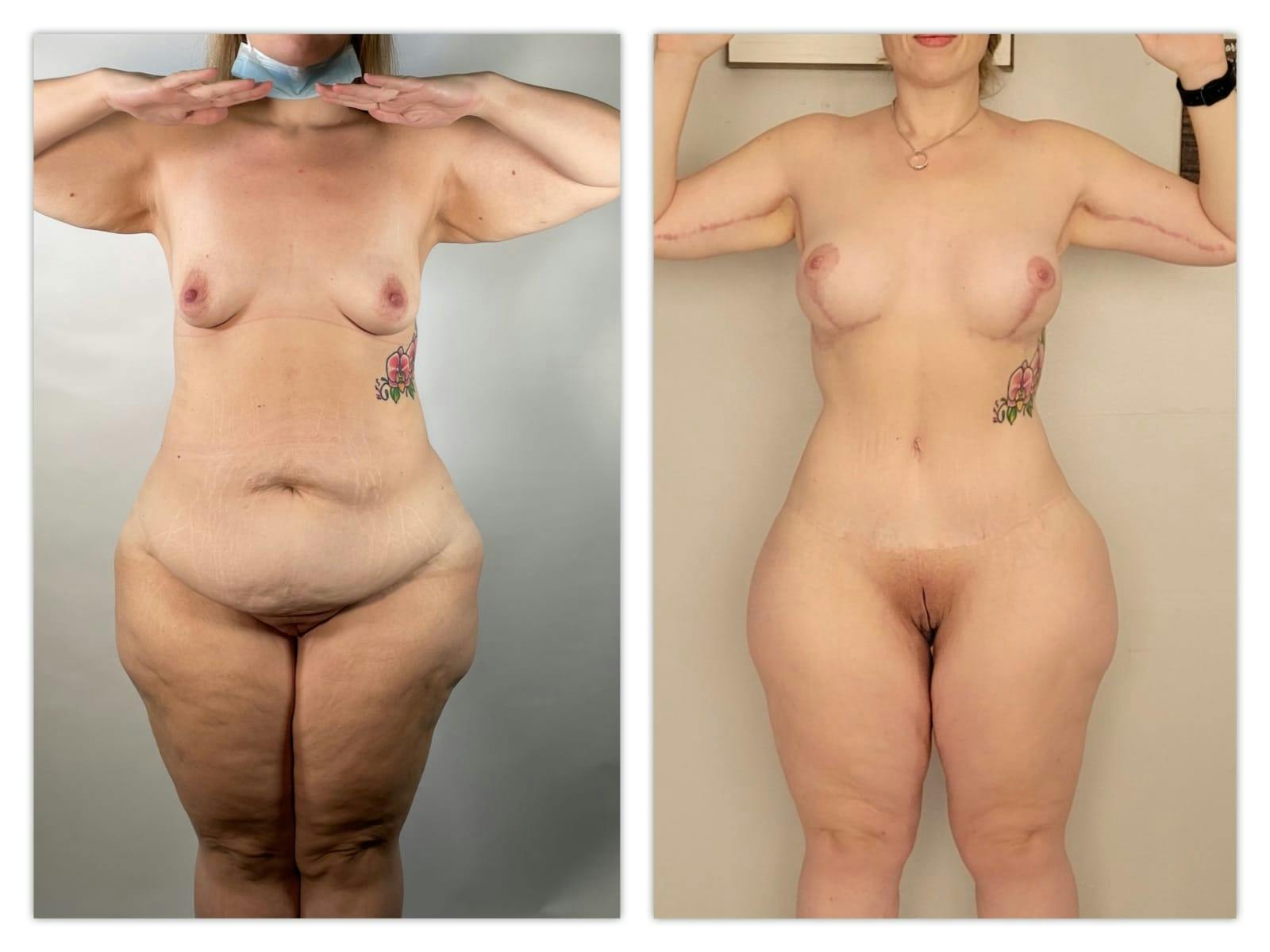 Mommy Makeover Before & After Gallery - Patient 133183633 - Image 1