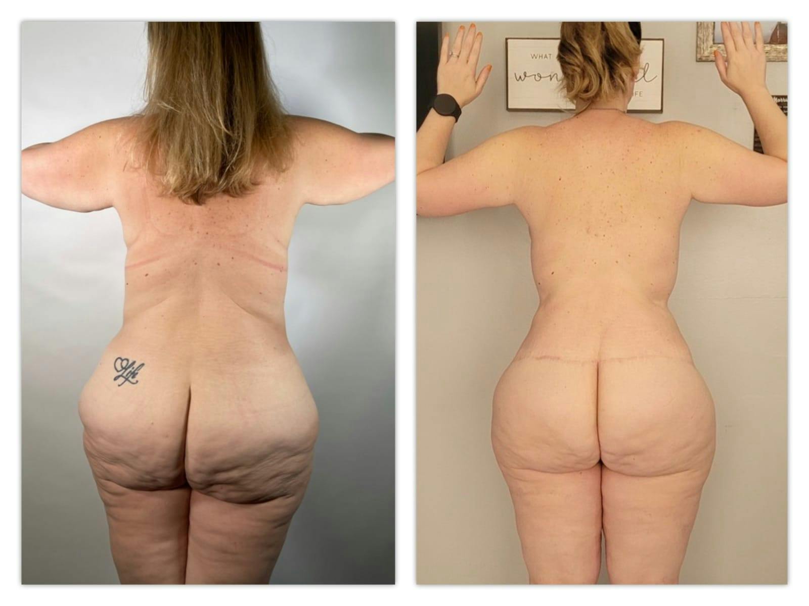 Mommy Makeover Before & After Gallery - Patient 133183633 - Image 3