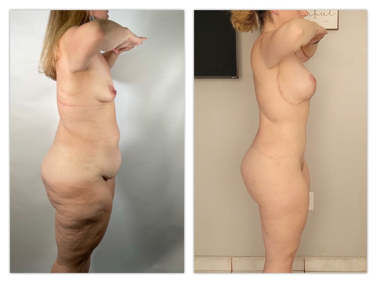 Mommy Makeover Before & After Gallery - Patient 133183633 - Image 2