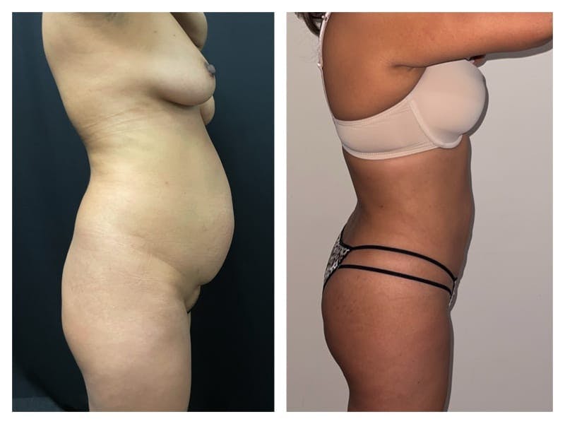 Brazilian Butt Lift Before & After Gallery - Patient 133183627 - Image 4
