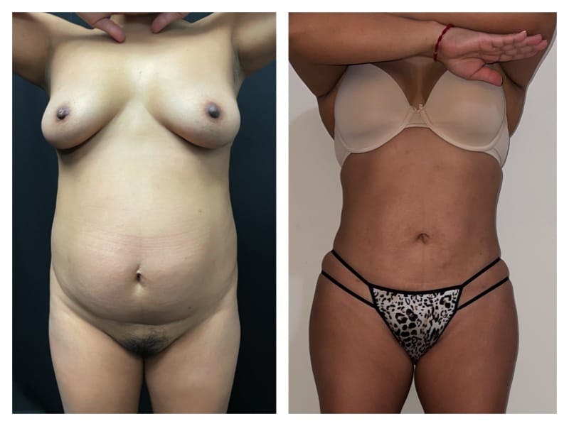 Brazilian Butt Lift Before & After Gallery - Patient 133183627 - Image 2