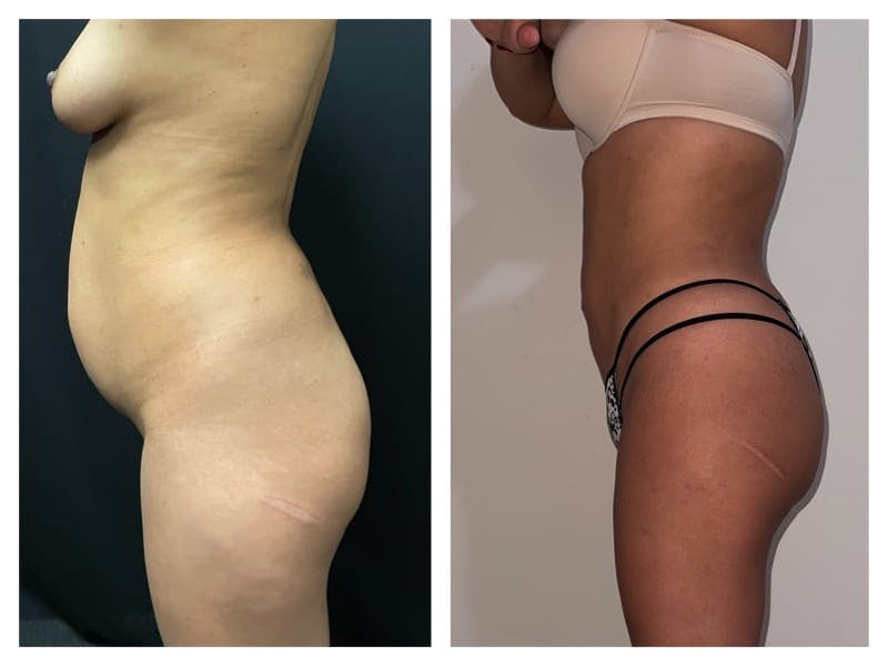 Brazilian Butt Lift Before & After Gallery - Patient 133183627 - Image 3
