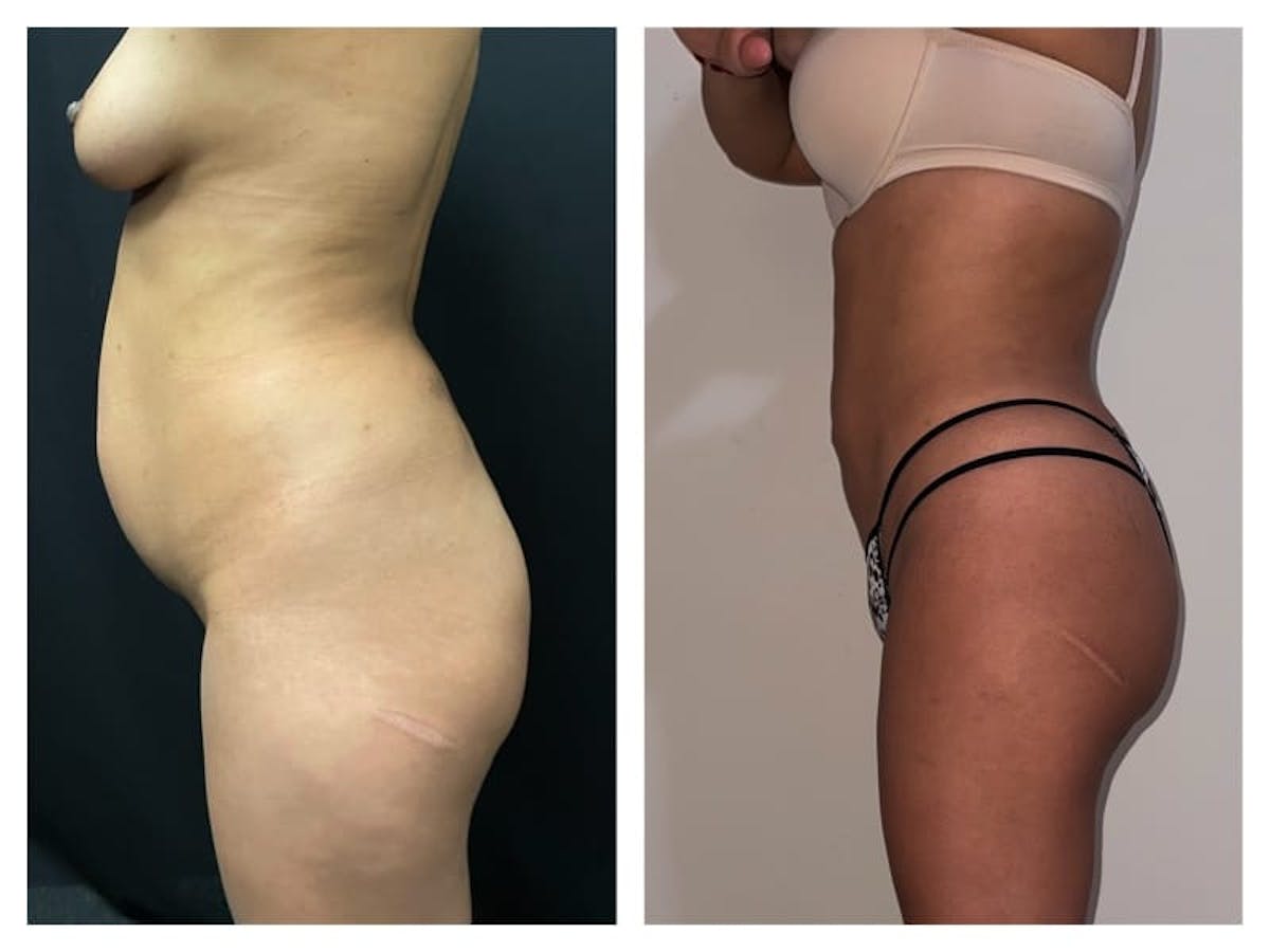 Brazilian Butt Lift Before & After Gallery - Patient 133183627 - Image 2