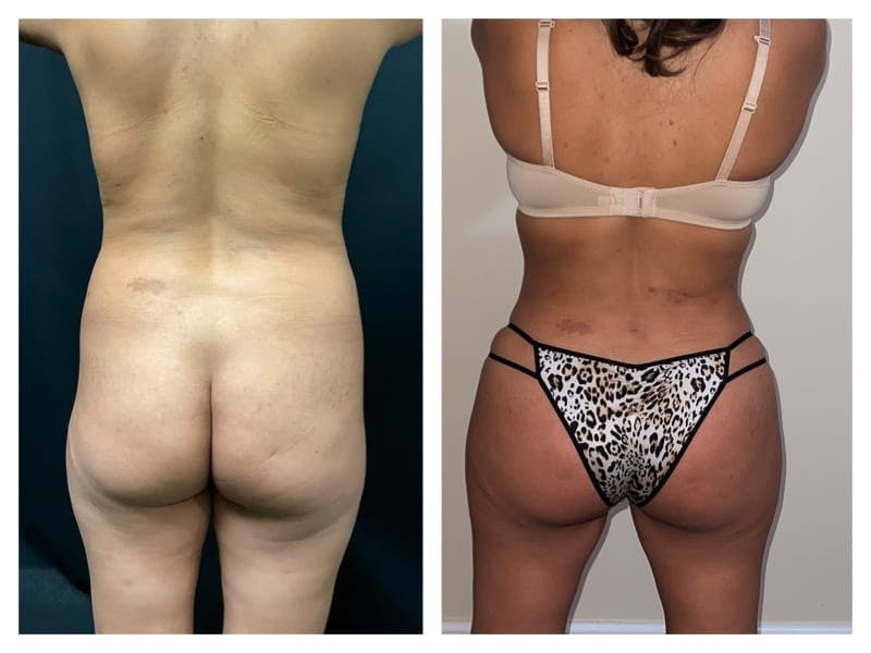 Brazilian Butt Lift Before & After Gallery - Patient 133183627 - Image 1