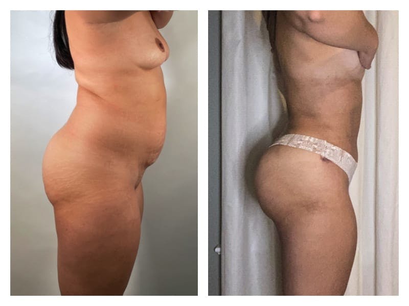 Brazilian Butt Lift Before & After Gallery - Patient 133183787 - Image 4