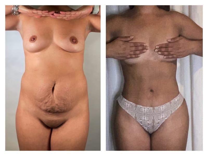 Brazilian Butt Lift Before & After Gallery - Patient 133183787 - Image 2