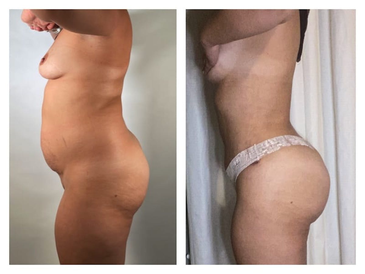 Brazilian Butt Lift Before & After Gallery - Patient 133183787 - Image 2