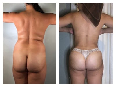 Brazilian Butt Lift Before & After Gallery - Patient 133183787 - Image 1