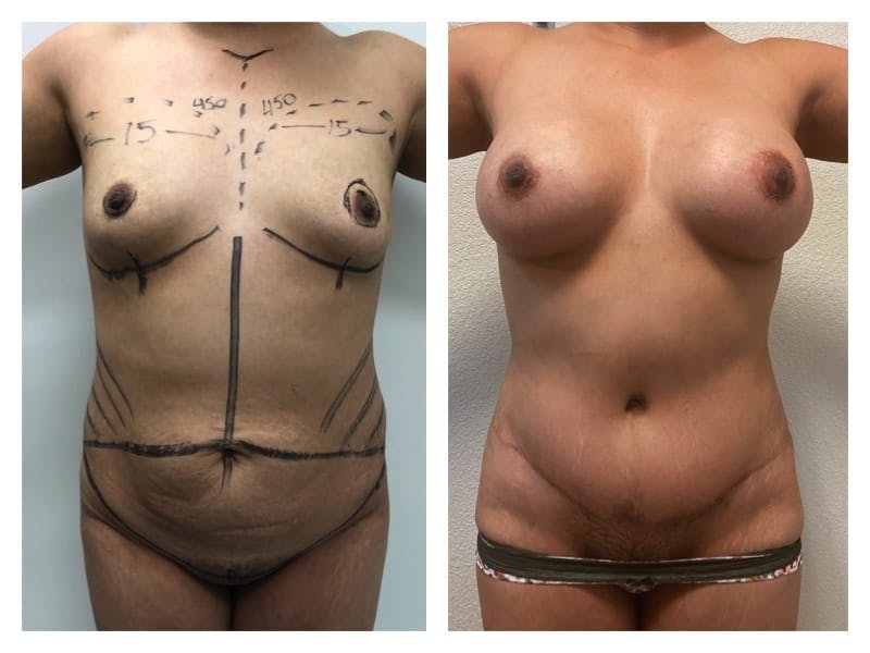 Mommy Makeover Before & After Gallery - Patient 133183639 - Image 1