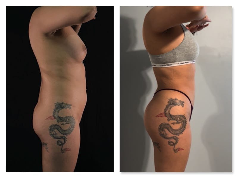 Brazilian Butt Lift Before & After Gallery - Patient 133183814 - Image 4