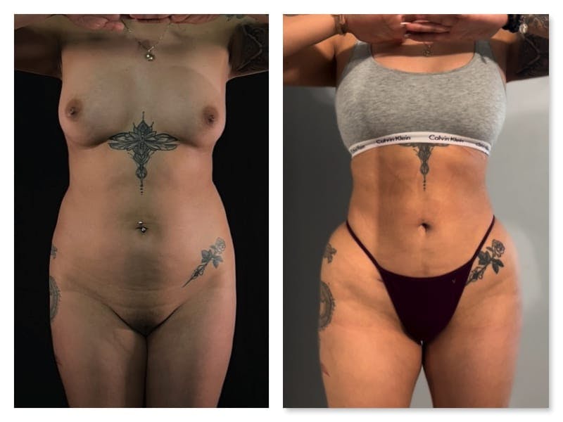 Brazilian Butt Lift Before & After Gallery - Patient 133183814 - Image 2