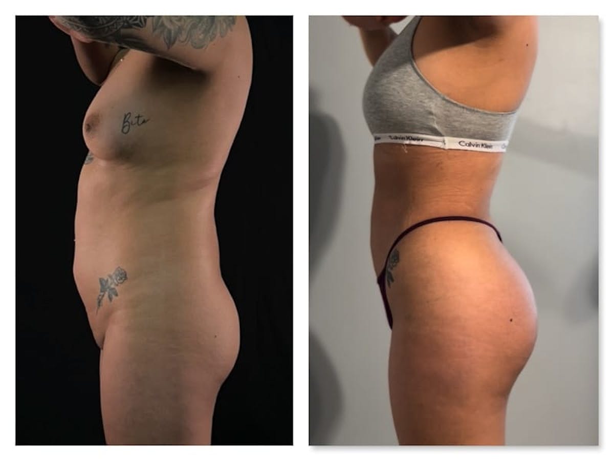 Brazilian Butt Lift Before & After Gallery - Patient 133183814 - Image 2
