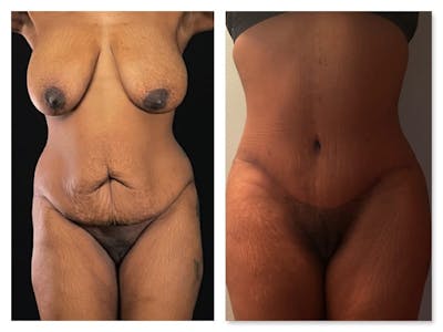 Tummy Tuck Before & After Gallery - Patient 133183894 - Image 1
