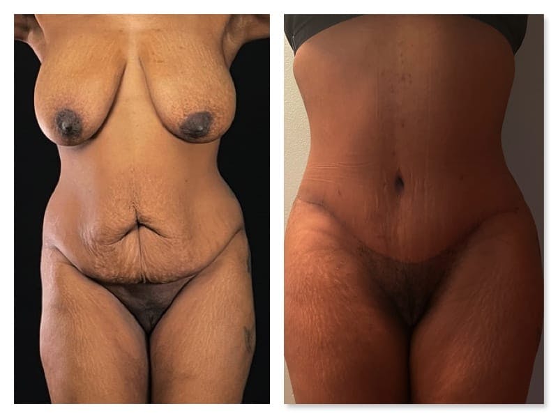 Brazilian Butt Lift Before & After Gallery - Patient 133183896 - Image 2