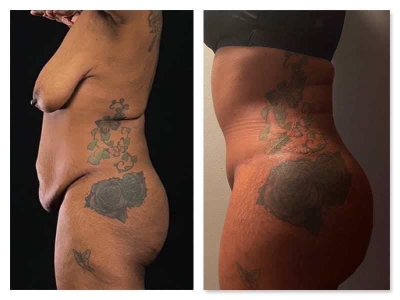 Brazilian Butt Lift Before & After Gallery - Patient 133183896 - Image 3