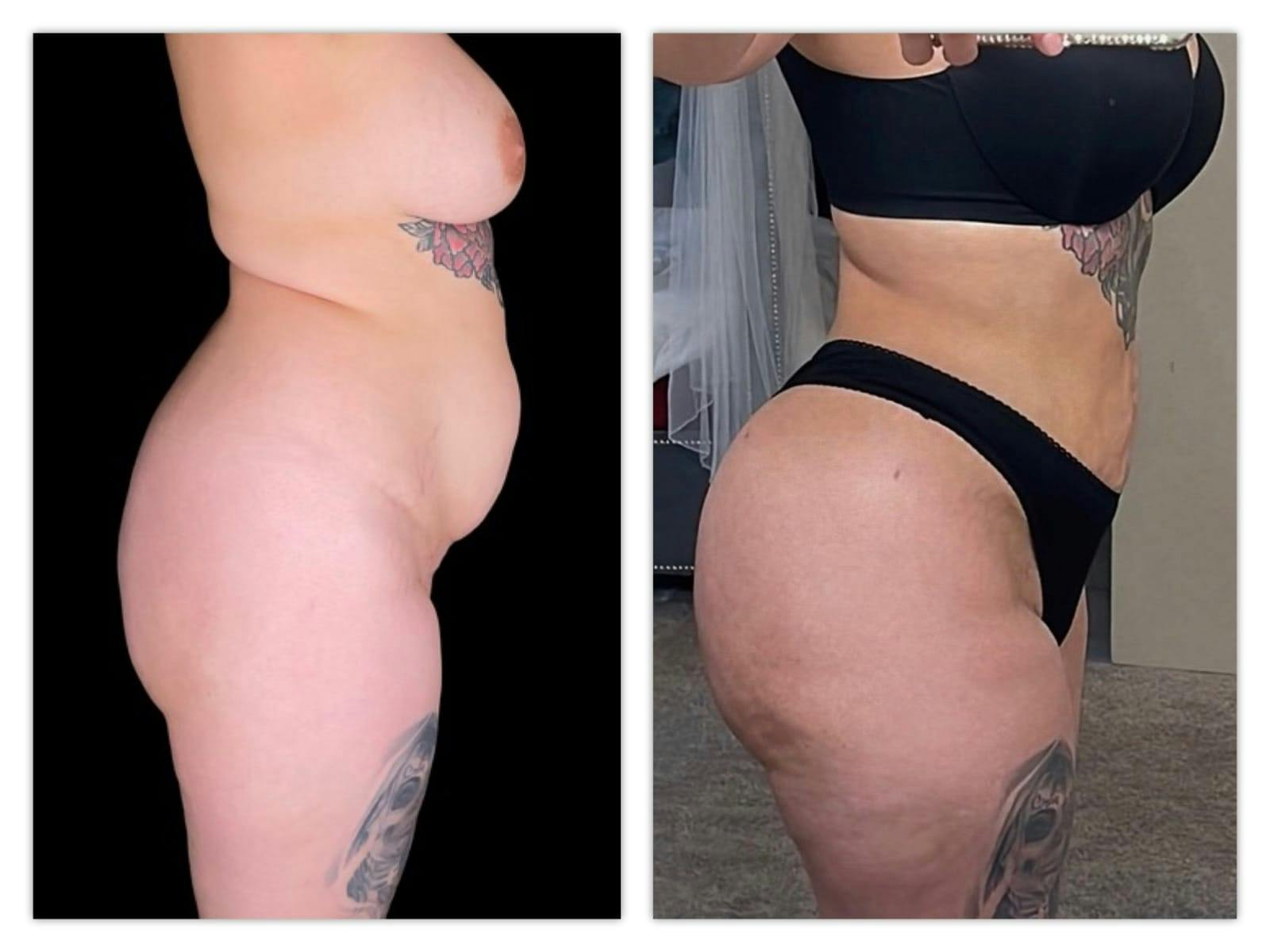 Brazilian Butt Lift Before & After Gallery - Patient 133183820 - Image 4