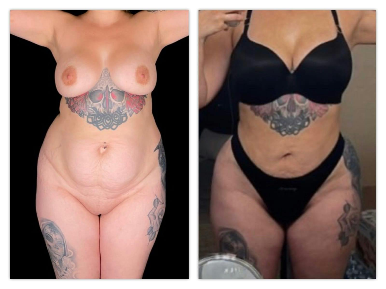 Brazilian Butt Lift Before & After Gallery - Patient 133183820 - Image 3