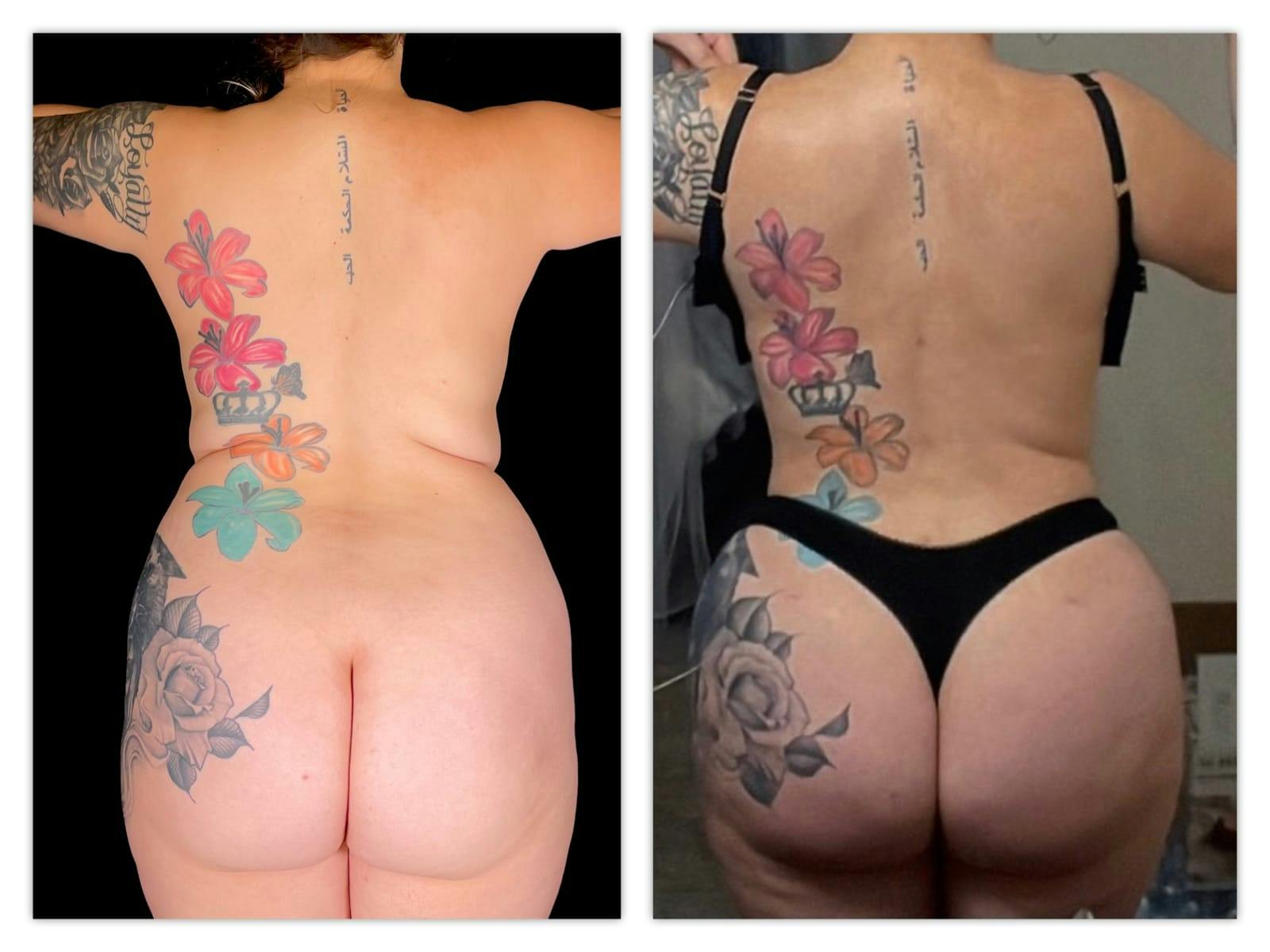 Brazilian Butt Lift Before & After Gallery - Patient 133183820 - Image 1