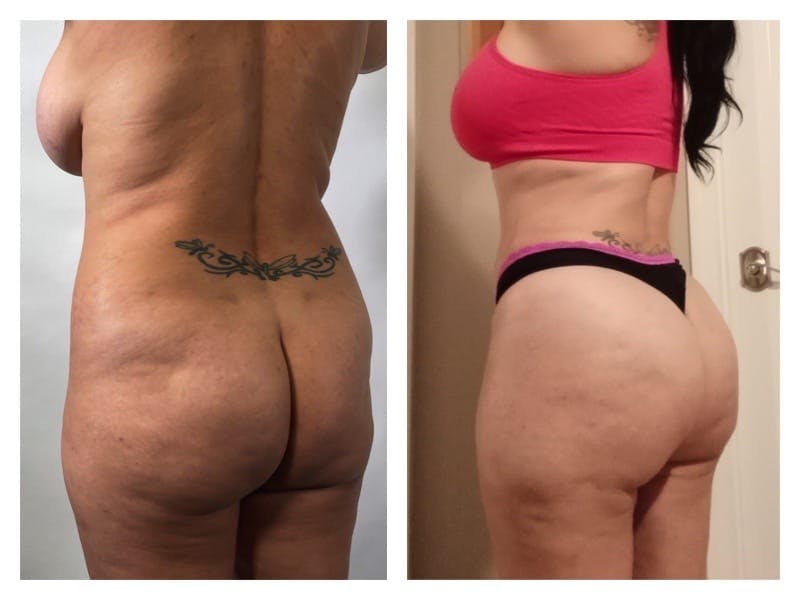 Brazilian Butt Lift Before & After Gallery - Patient 133183866 - Image 2