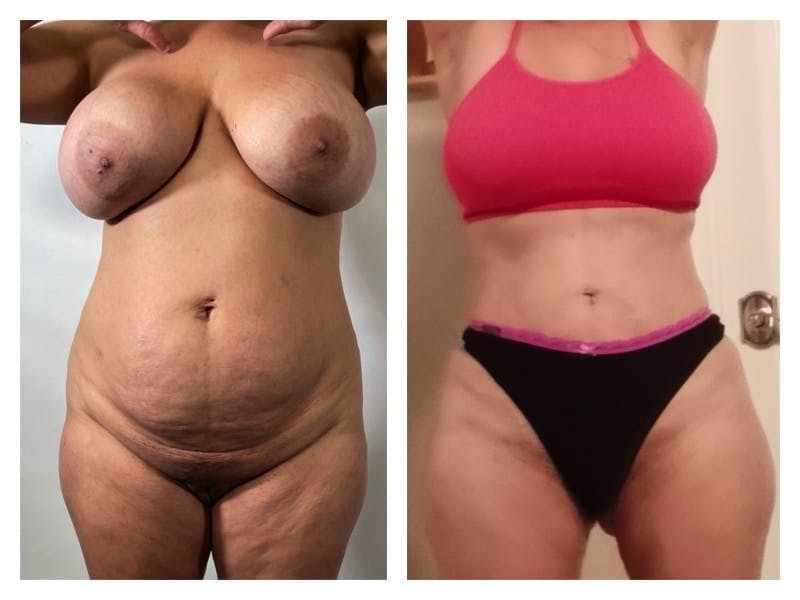Brazilian Butt Lift Before & After Gallery - Patient 133183866 - Image 3