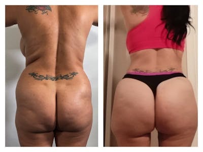 Brazilian Butt Lift Before & After Gallery - Patient 133183866 - Image 1