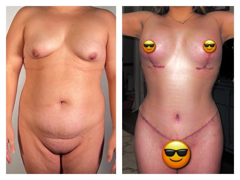 Mommy Makeover Before & After Gallery - Patient 133183884 - Image 1