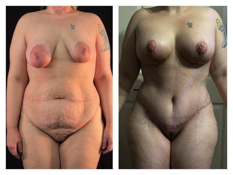 Mommy Makeover Before & After Gallery - Patient 133183867 - Image 7