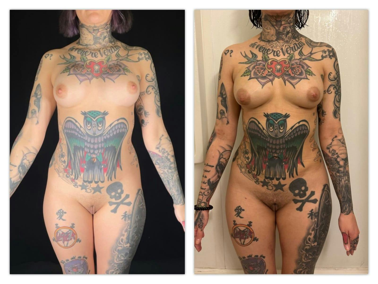 Liposuction Before & After Gallery - Patient 133183652 - Image 1