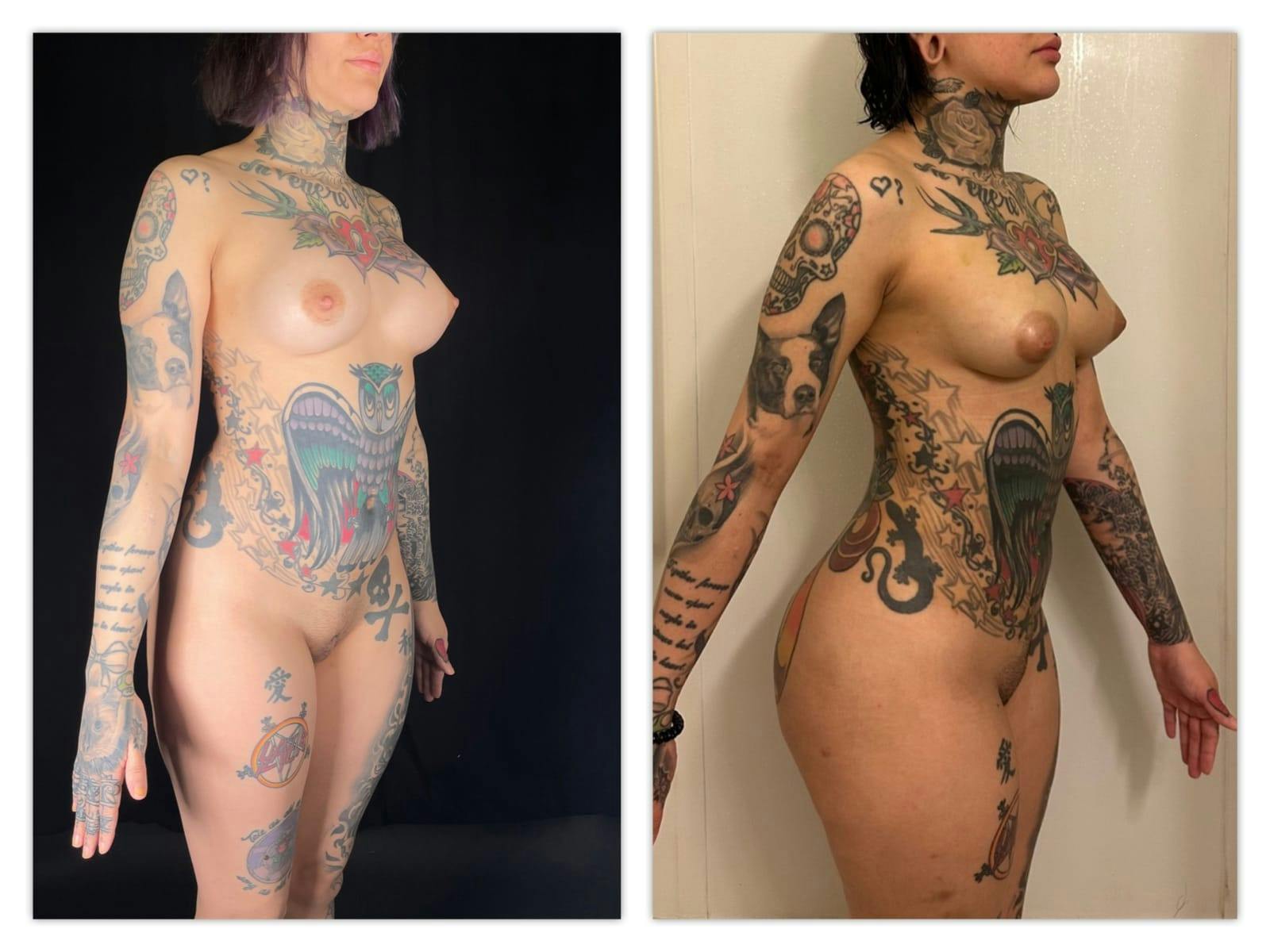 Liposuction Before & After Gallery - Patient 133183652 - Image 3