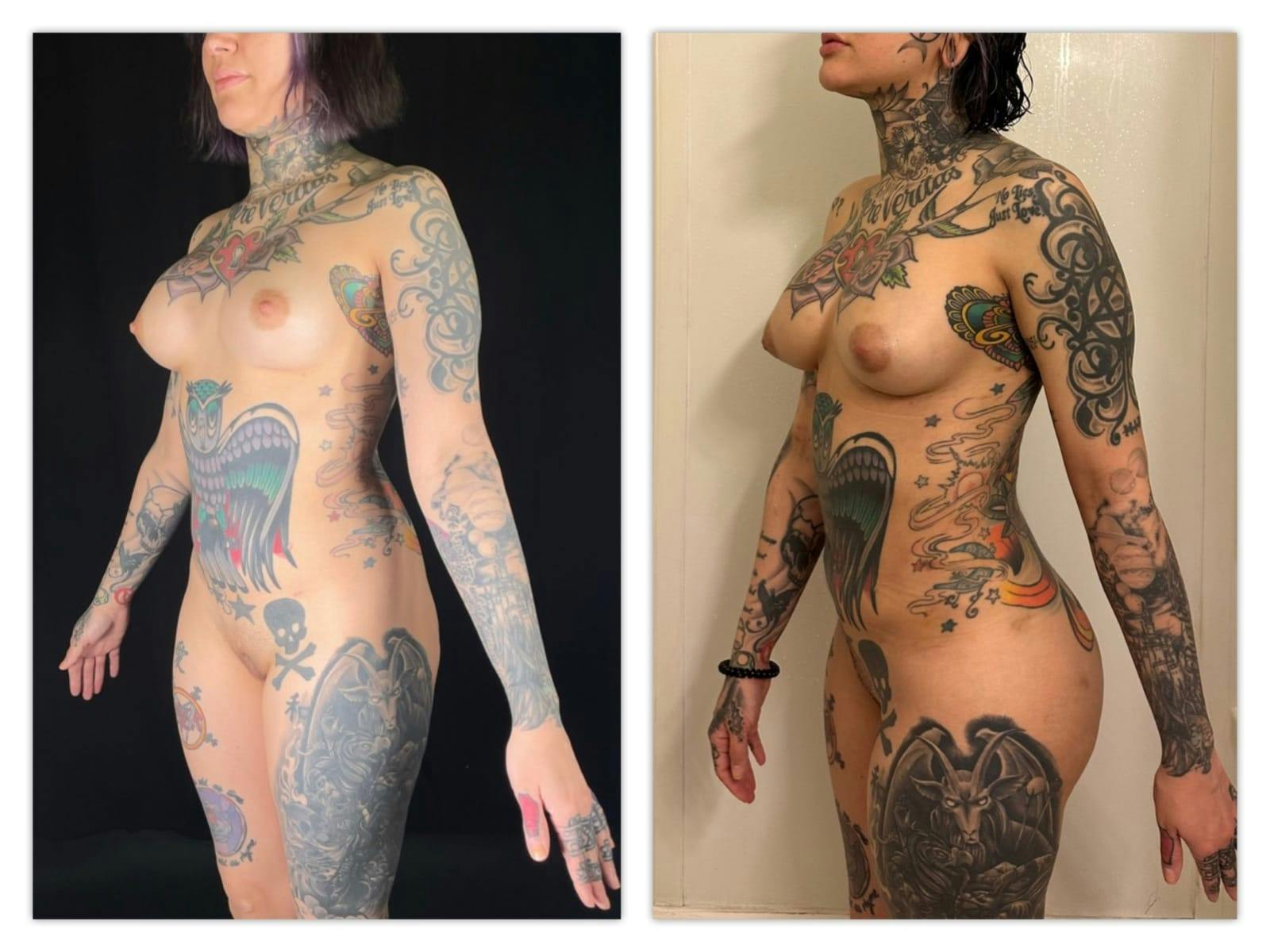 Liposuction Before & After Gallery - Patient 133183652 - Image 4