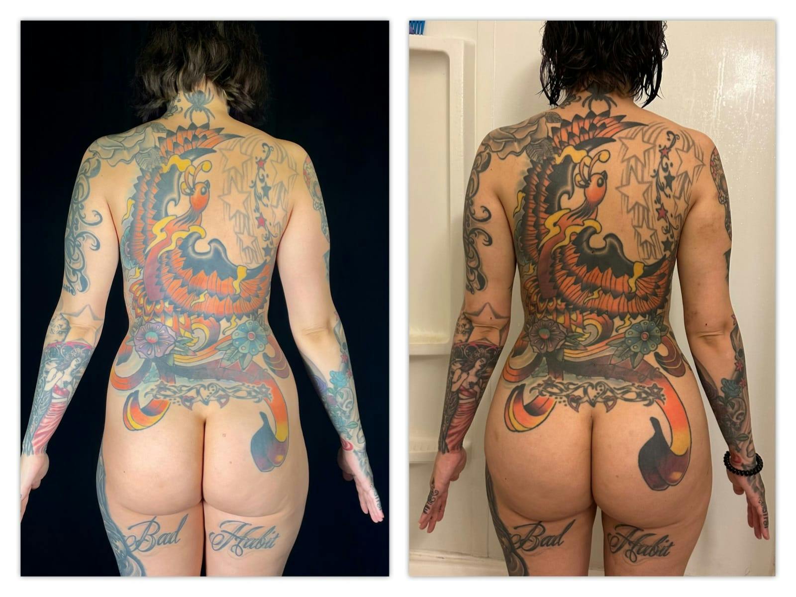 Liposuction Before & After Gallery - Patient 133183652 - Image 2