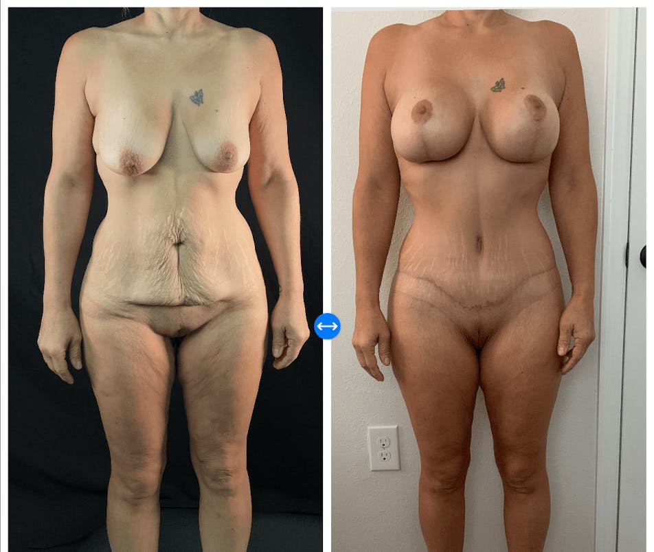 Mommy Makeover Before & After Gallery - Patient 133183632 - Image 5