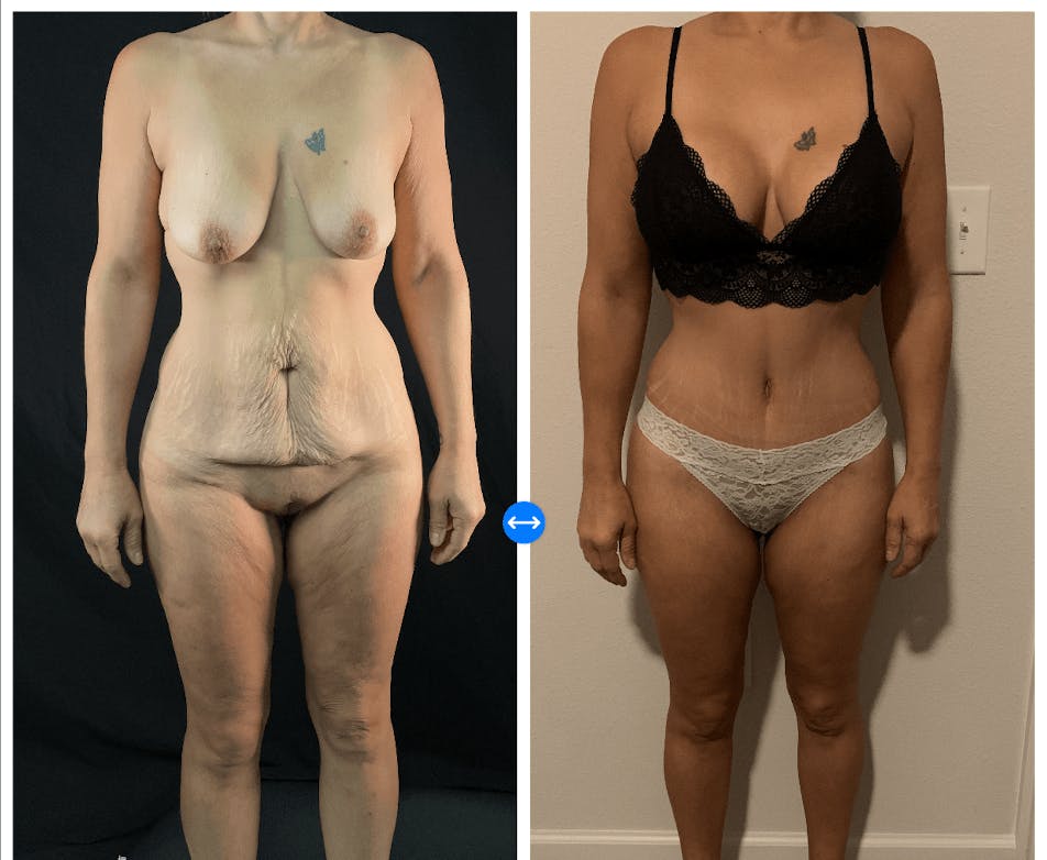 Mommy Makeover Before & After Gallery - Patient 133183632 - Image 1