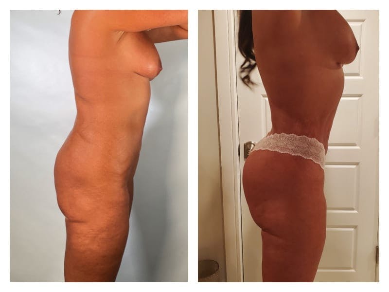 Brazilian Butt Lift Before & After Gallery - Patient 133183670 - Image 4