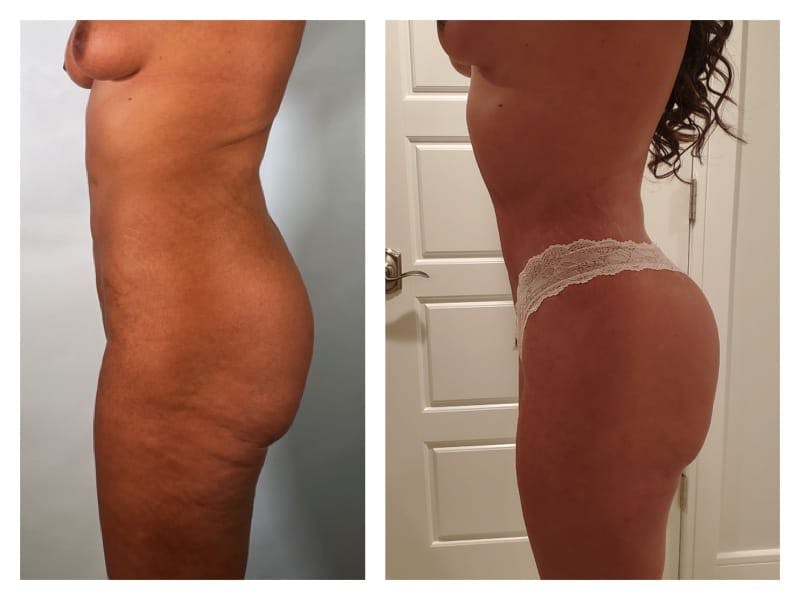 Brazilian Butt Lift Before & After Gallery - Patient 133183670 - Image 3