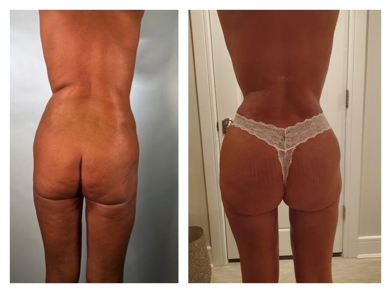 Brazilian Butt Lift Before & After Gallery - Patient 133183670 - Image 1