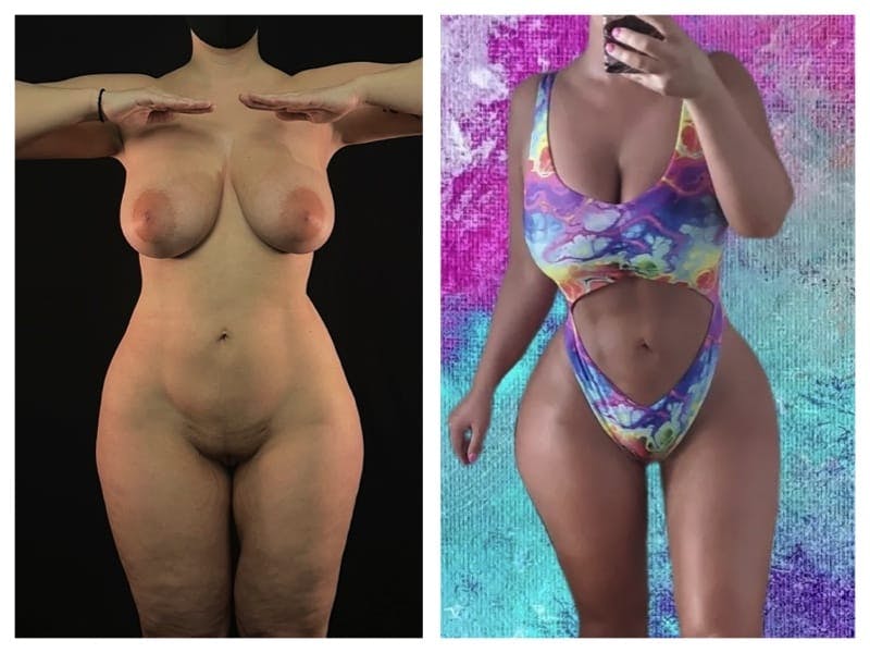 Liposuction Before & After Gallery - Patient 133183630 - Image 1