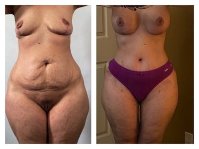 Mommy Makeover Before & After Gallery - Patient 133183886 - Image 1