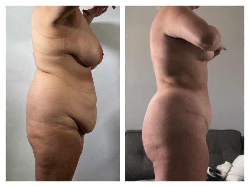 Tummy Tuck Before & After Gallery - Patient 133183890 - Image 4