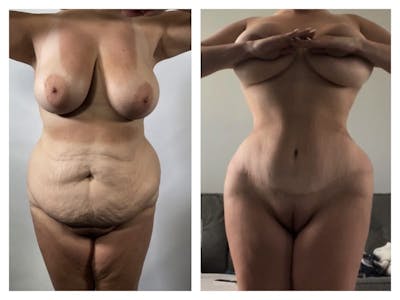 Tummy Tuck Before & After Gallery - Patient 133183890 - Image 1