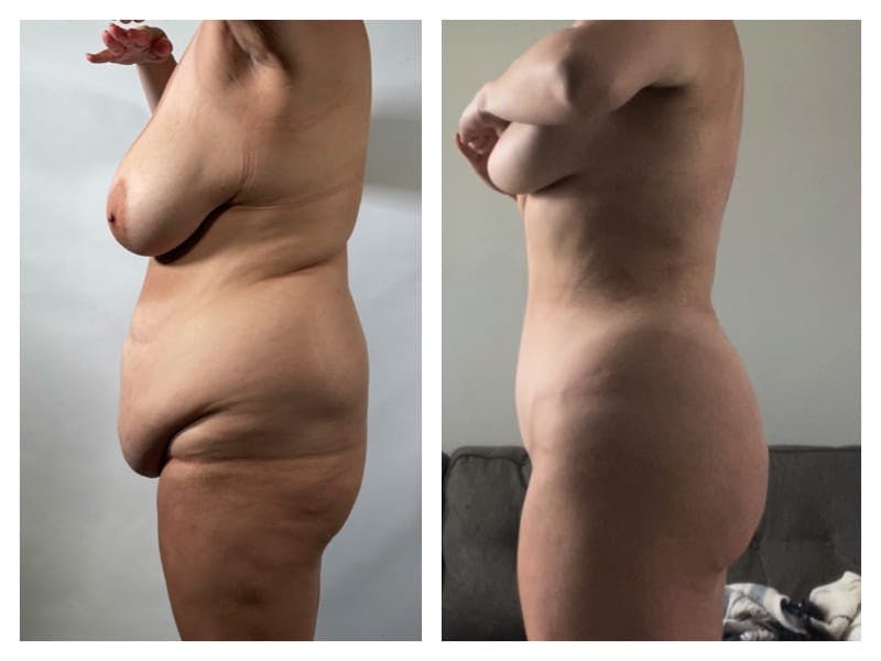 Tummy Tuck Before & After Gallery - Patient 133183890 - Image 3