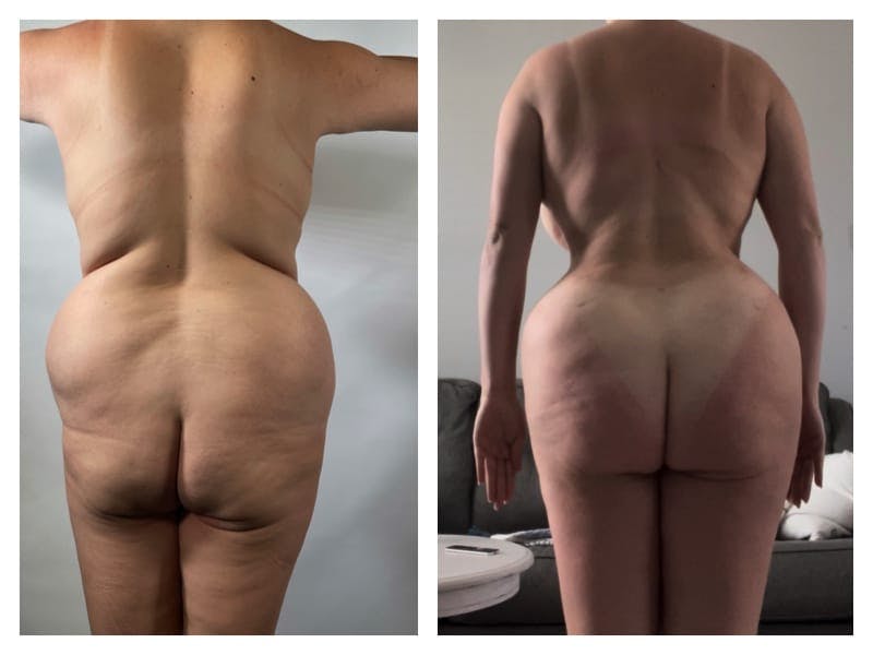 Tummy Tuck Before & After Gallery - Patient 133183890 - Image 2