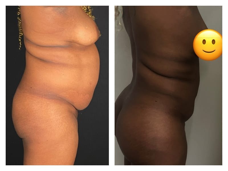 Brazilian Butt Lift Before & After Gallery - Patient 133183864 - Image 4