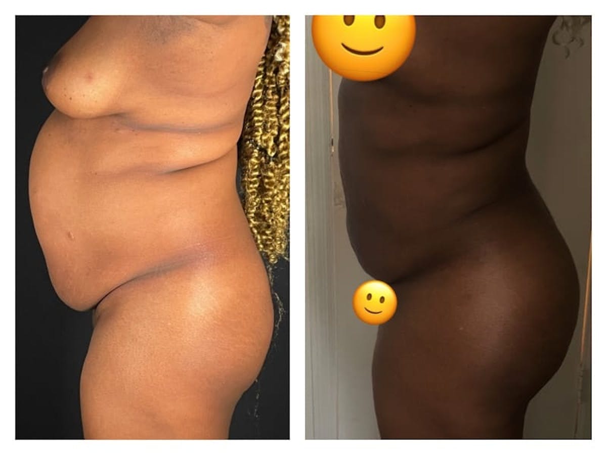 Brazilian Butt Lift Before & After Gallery - Patient 133183864 - Image 2