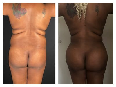 Brazilian Butt Lift Before & After Gallery - Patient 133183864 - Image 1