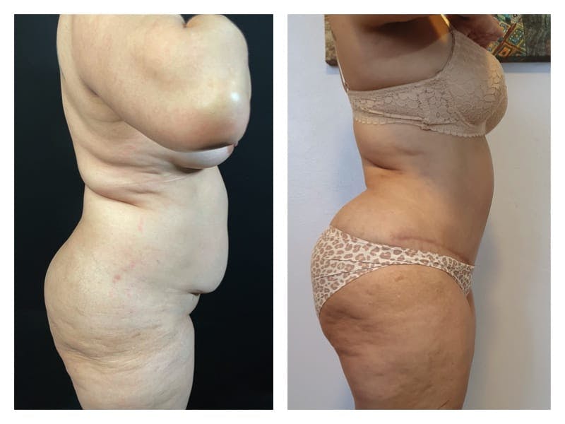 Tummy Tuck Before & After Gallery - Patient 133183818 - Image 4